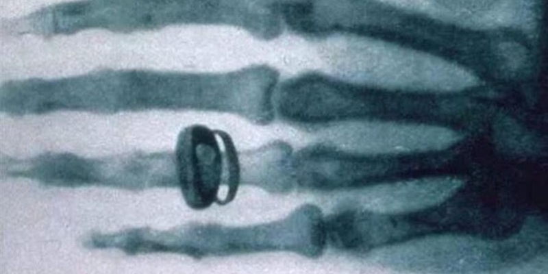 1895 - Prima radiografia della storia