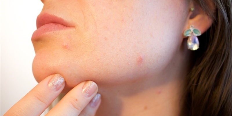 L'acne: come prevenirla con una corretta alimentazione