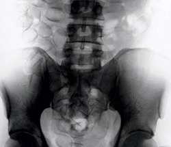 Cocaina. Venezuelano atterra a Firenze con 91 ovuli nello stomacaco. 'Radiografato' e arrestato...