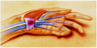 La sindrome del tunnel carpale