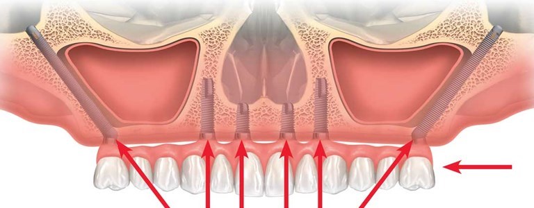 Trattamento dell’edentulia: dal problema alla soluzione il passo può essere breve.